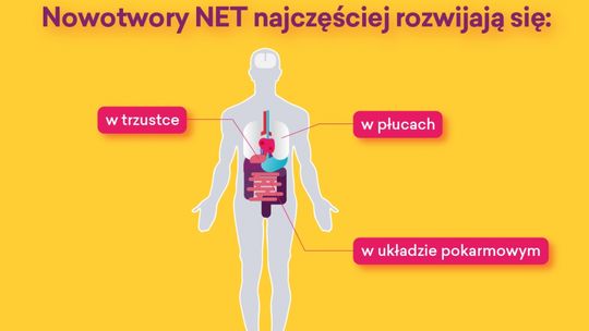 NOWOTWORY NEUROENDOKRYNNE –  INNE NIŻ WSZYSTKIE