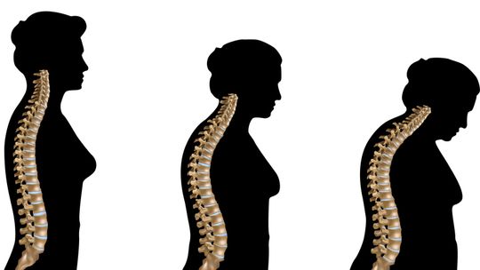 Osteoporoza - cichy złodziej kości!