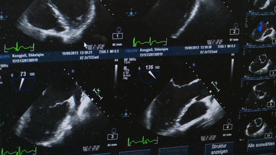 Rak nerki latami rozwija się bezobjawowo. Tymczasem zdiagnozować go może proste badanie USG jamy brzusznej
