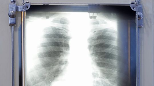 Raport: do 2040 r. koszty opieki nad chorymi z rakiem płuca mogą wzrosnąć do ok. 20 mld rocznie