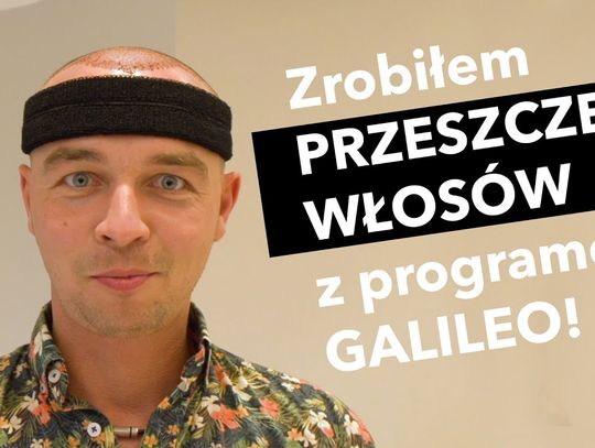 Program Galileo sprawdza, jak wygląda przeszczep włosów w Turcji