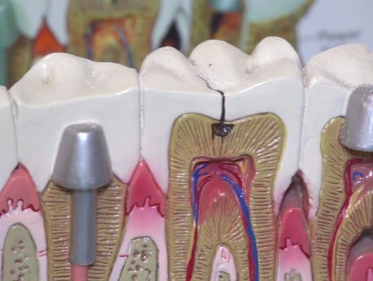 W twojej plombie może kryć się rtęć