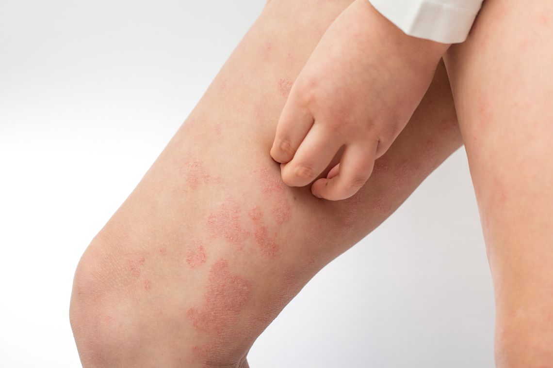 Łojotokowe zapalenie skóry – poznaj przyczyny choroby!