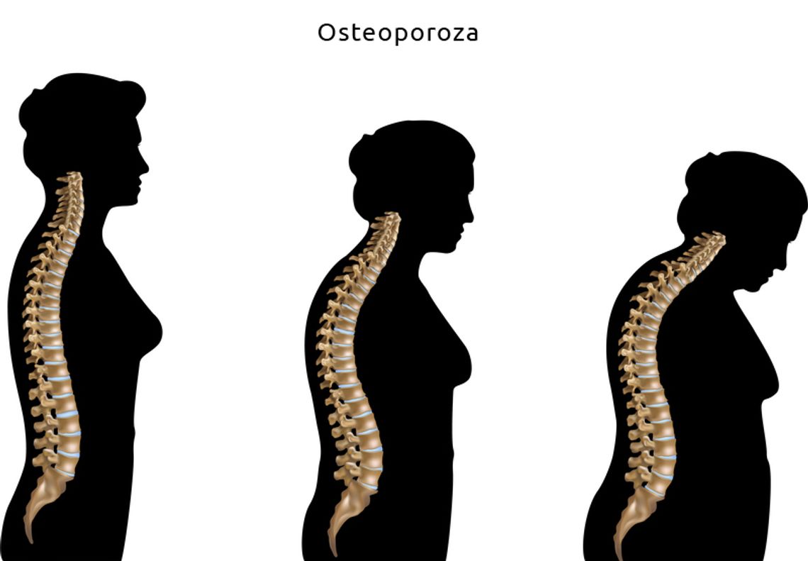 Osteoporoza - cichy złodziej kości!