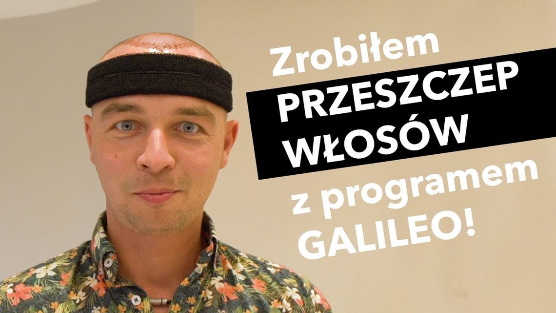 Program Galileo sprawdza, jak wygląda przeszczep włosów w Turcji