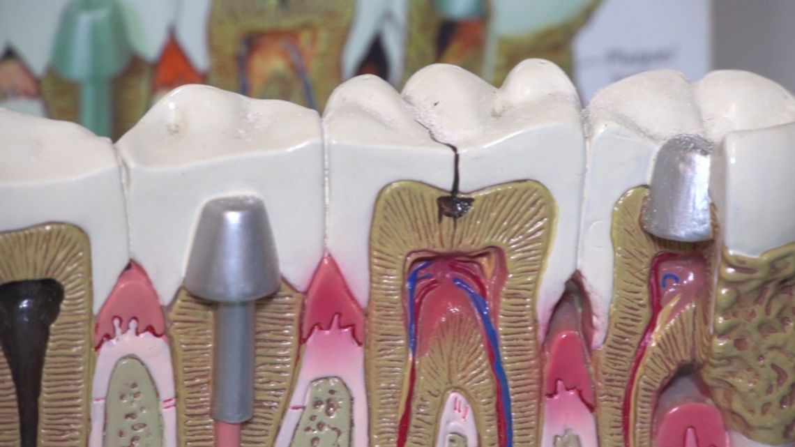 W twojej plombie może kryć się rtęć